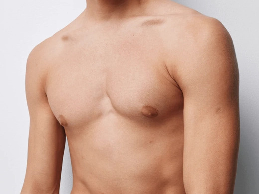 Male Breast Reduction (Gynecomastia)